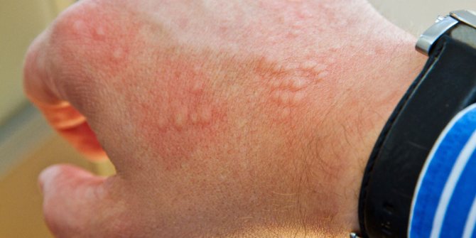 Аллергический дерматит у детей (29 фото): симптомы и лечение грудничков и новорожденных, кремы и мази в домашних условиях