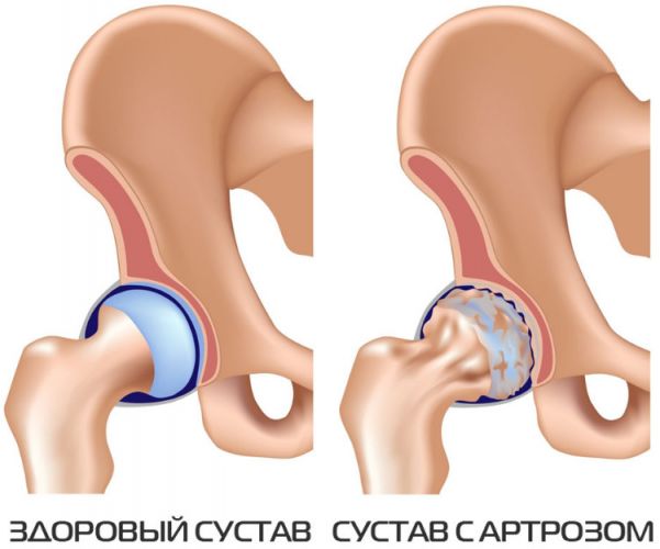 Питание при коксартрозе тазобедренного сустава 2 степени бубновский