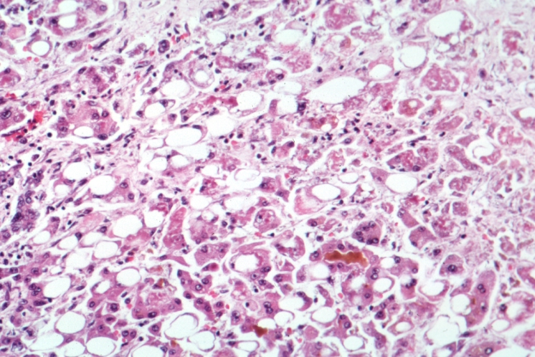 Возбудитель вирусного гепатита а: характеристики, свойства, устойчивость и профилактика