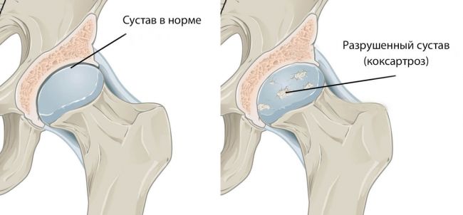 Каким должно быть правильное питание при коксартрозе тазобедренного сустава 1, 2 и 3 степени?