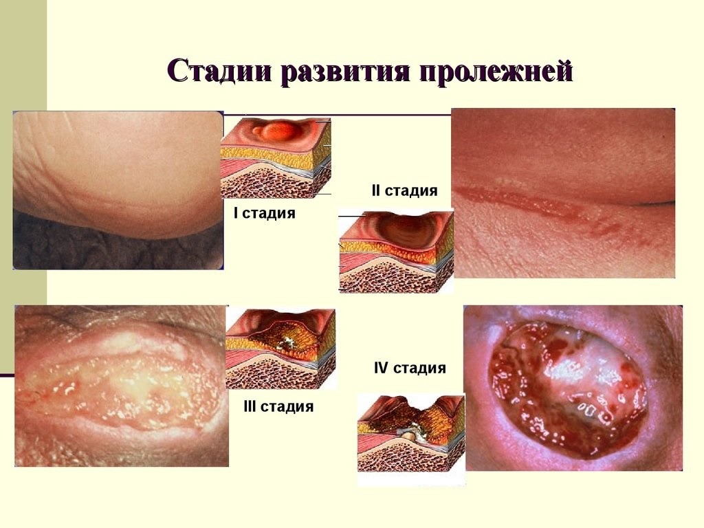 Профилактика пролежней, алгоритм выполнения