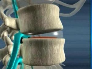 Защемление нерва в пояснице — причины, симптомы и лечение