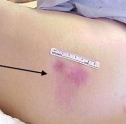 Как обрабатывать пролежни у лежачих больных