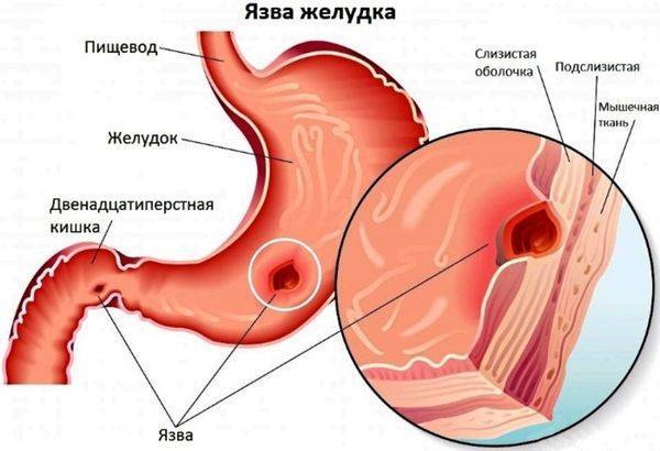 Боль в правом подреберье при кашле причины и возможные заболевания