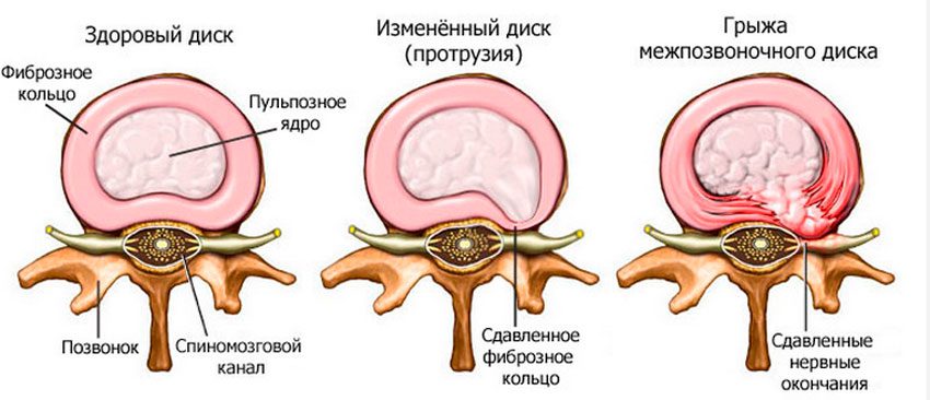 Защемление нерва в спине: что делать, если защемило, симптомы, как лечить