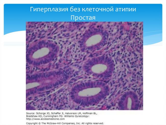 Железистая гиперплазия эндометрия лечение