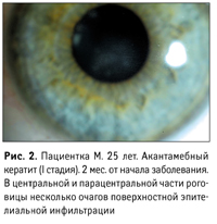 Кератит