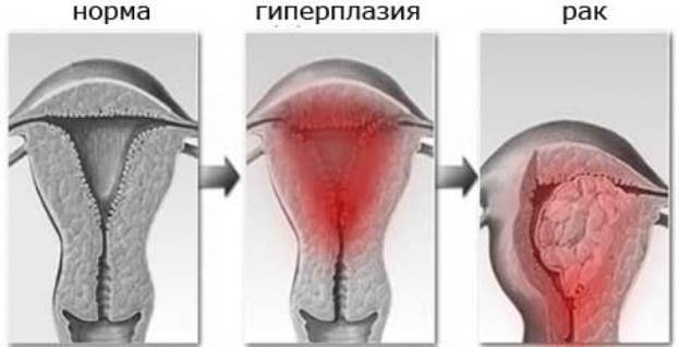 Очаговая гиперплазия эндометрия