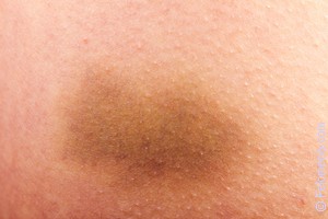 Чем отличается гематома от синяка? виды гематом. медицинские термины
