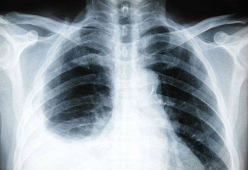 При вздохе болит правый бок под ребрами