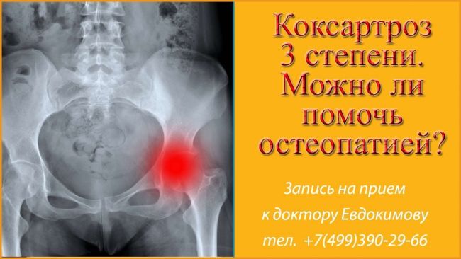 Питание при коксартрозе тазобедренного сустава лечение