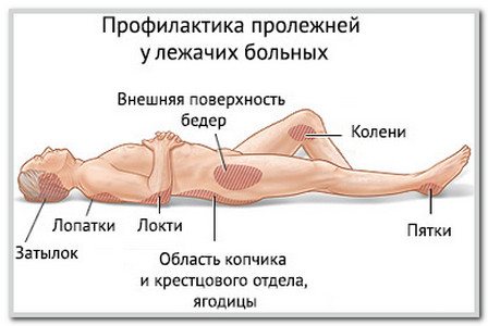 Быстро вылечить пролежни и снять симптомы