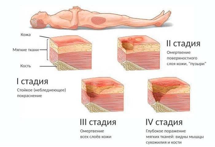 Опрелости и пролежни: как лечить на разных стадиях