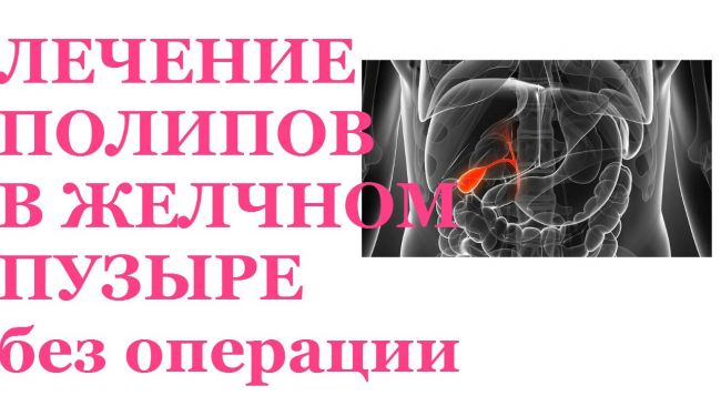 Симптомы и лечение полипов желчного пузыря — медицинские рекомендации