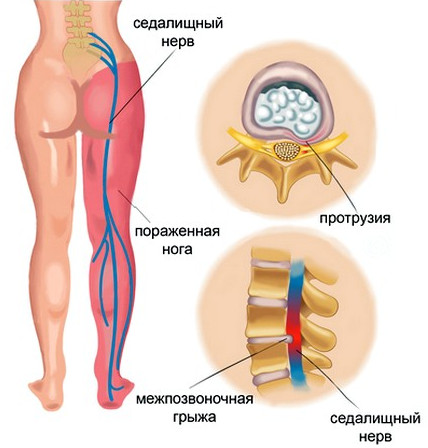Лечение защемления нерва в пояснице - опасность защемления, диагностика, первая помощь, методы лечения