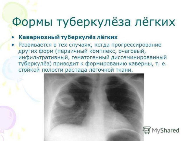 Диссеминированный туберкулез