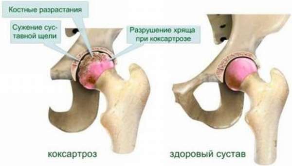 Диета и питание при коксартрозе