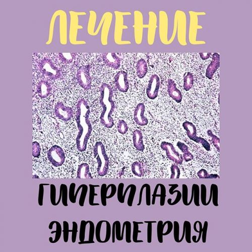 Гиперплазия