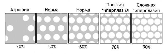Что такое очаговая гиперплазия эндометрия: симптомы и лечение