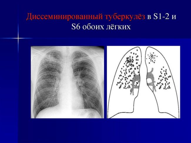История болезнидиссеминированный туберкулез. фаза распада. мбт (-). процесс подострый