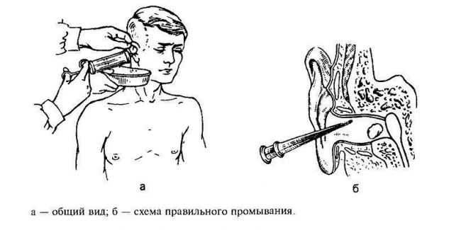 При насморке заложило уши как лечить доступным способом