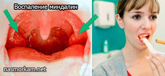 Что делать, если заложило ухо при насморке?