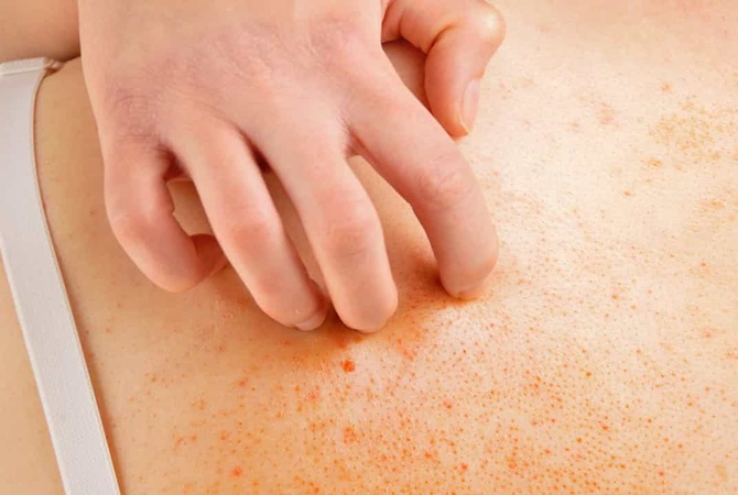 Аллергический дерматит: симптомы и лечение