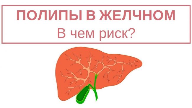 Основы питания при полипах в желчном пузыре — диета №5