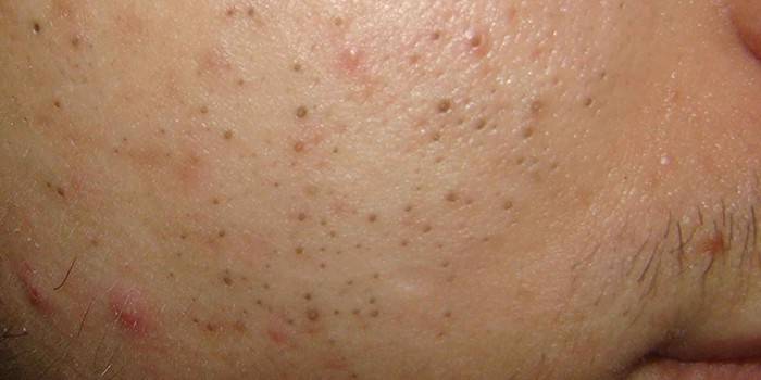Ретиноевая мазь (retinoic ointment)
