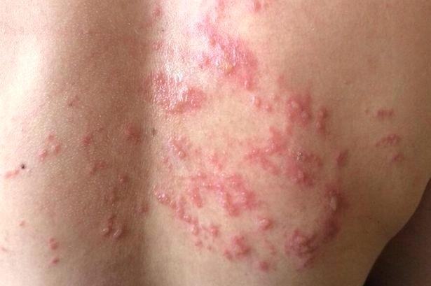 Аллергический дерматит: симптомы и лечение аллергического дерматита у детей и взрослых