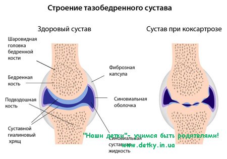 Правильное питание при коксартрозе – залог успешного лечения