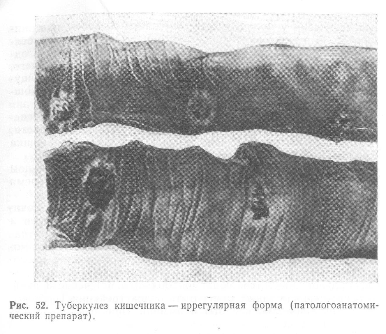 Как передается туберкулез? формы туберкулеза. туберкулез: симптомы, как передается