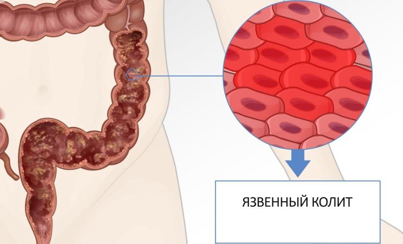 Диета при колите кишечника: правила питания, меню и рецепты
