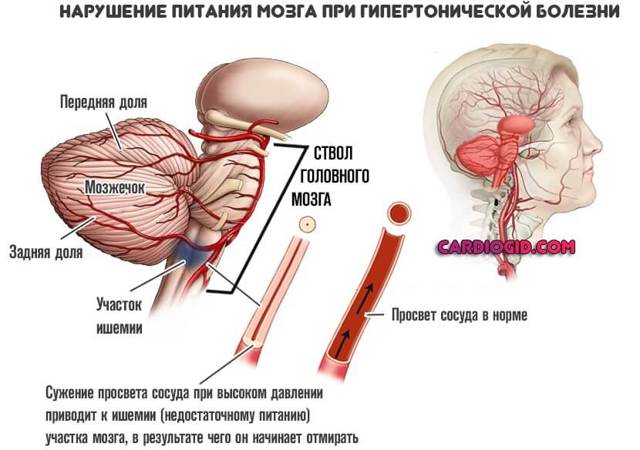 «милдронат», уколы: инструкция по применению, показания, дозировка, отзывы