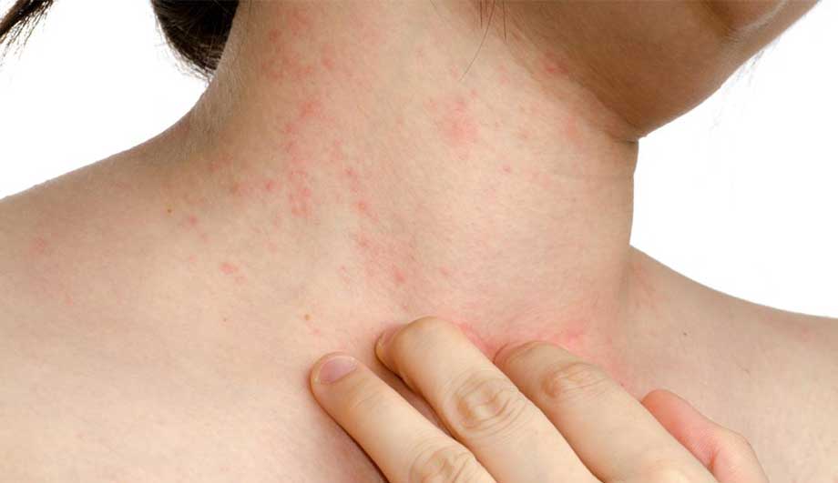 Дерматит кожи