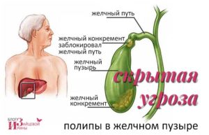 Симптомы и лечение полипов желчного пузыря — медицинские рекомендации