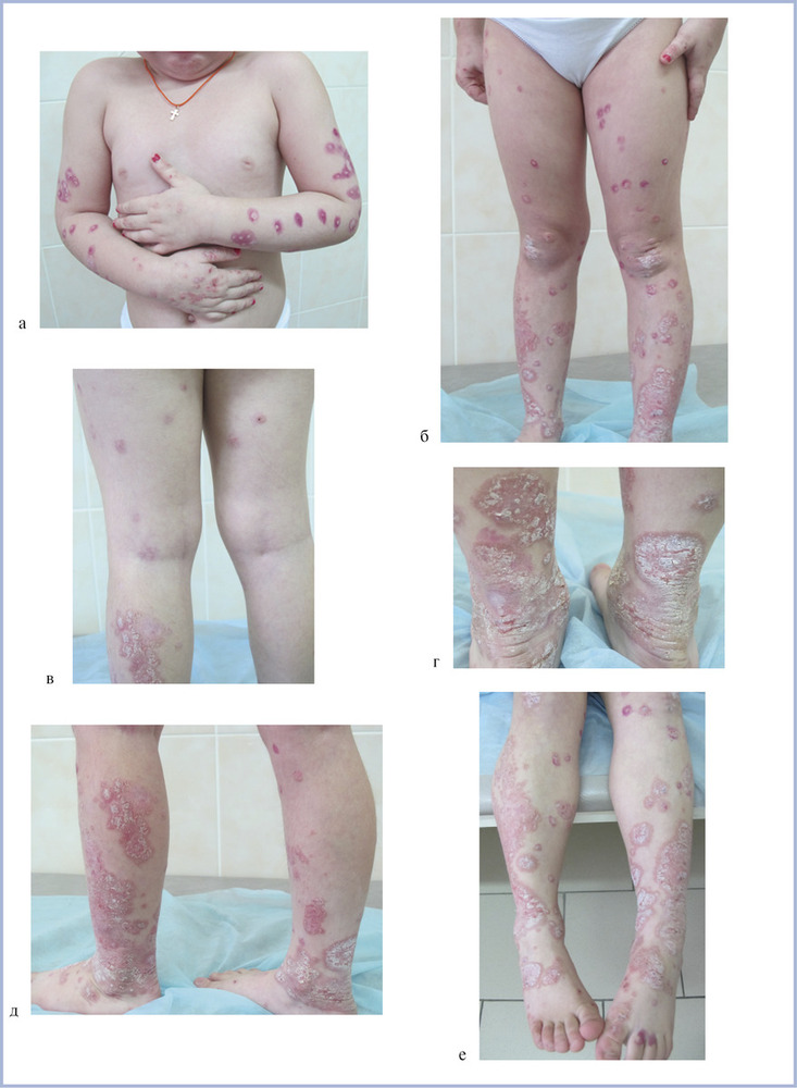 Аллергический дерматит. лечение у взрослых, причины, симптомы на руках, голове, лице. диета, мази, препараты в таблетках