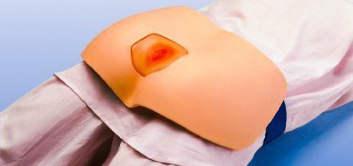 Опрелости у лежачих больных: причины, стадии, лечение