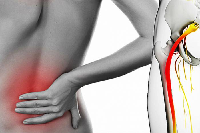 Защемило поясницу что делать