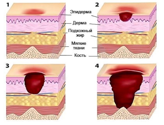 Опрелости и пролежни: как лечить на разных стадиях