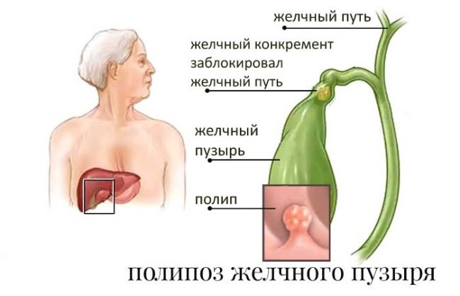 Как вылечить кальцинированный полип желчного пузыря?