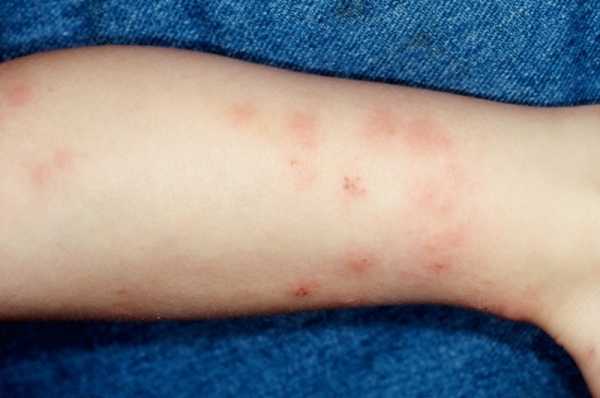 Аллергический дерматит у детей: симптомы, причины и правильное лечение