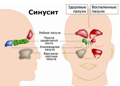 Кашель при гайморите: причины и симптомы
