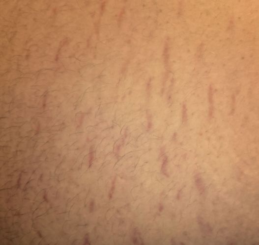 Почему на руках без причины появляются синяки и гематомы