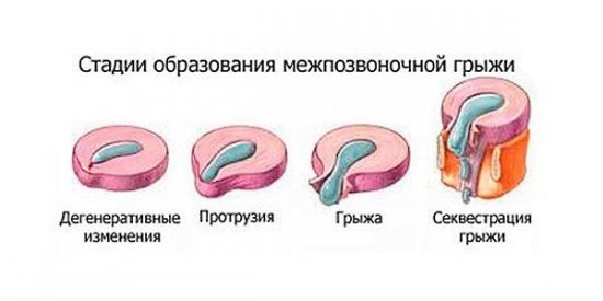 Симптомы и лечение грыжи грудного отдела позвоночника – быть или не быть операции?