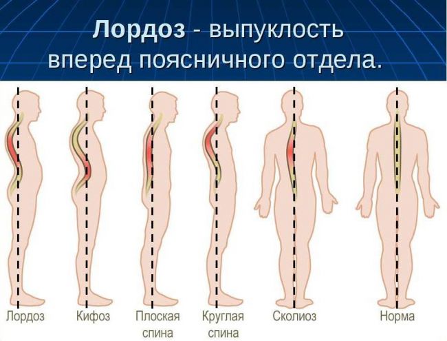 Поясничный лордоз: как распознать и что делать