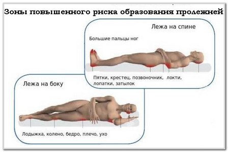 Пролежни. причины, стадии, профилактика и лечение пролежней у лежачих больных.