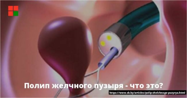 Что такое полип в желчном пузыре у ребёнка: причины возникновения, медикаментозное и хирургическое лечение