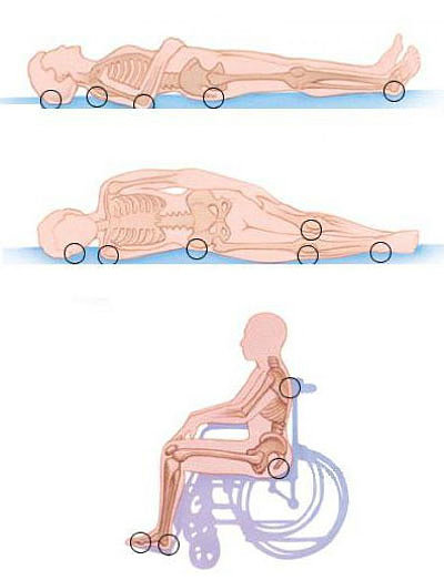 Как избежать и недопустить пролежней у больгого, народные способы лечения пролежней