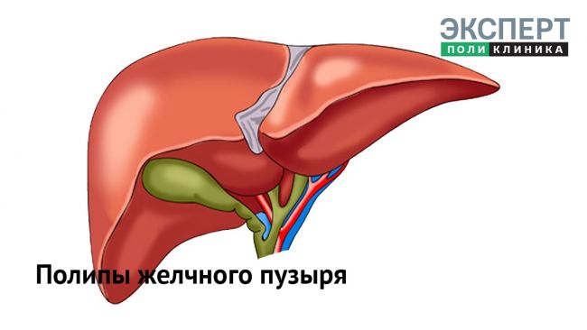 Полипоз желчного пузыря